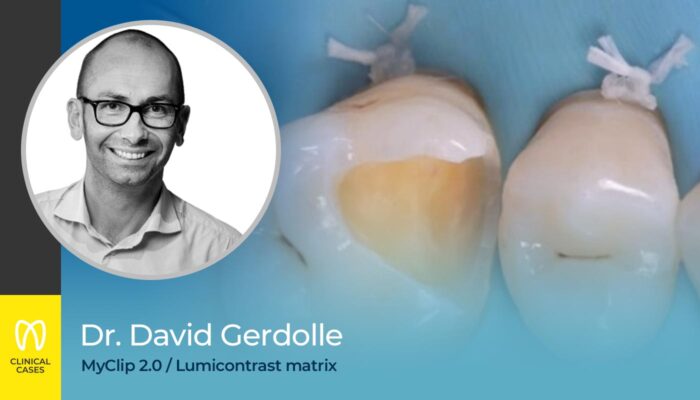 caso clinico Dr David Gerdolle classe II MO sul primo molare