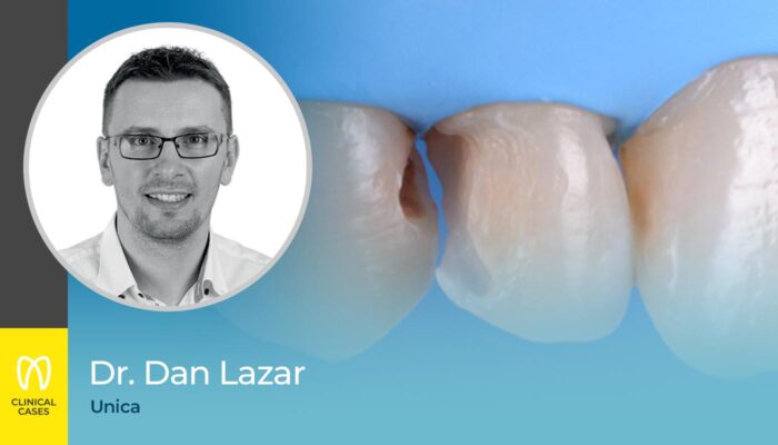caso clinico Dr Dan Lazar - restauro di classe III sui denti anteriori