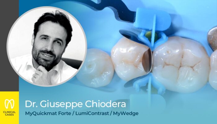 caso clinico Dr Giuseppe Chiodera - ricostruzione di classe II sul secondo premolare