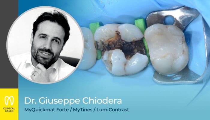 caso clinico Dr Giuseppe Chiodera - sostituzione di una vecchia amalgama e restauro di cavità di classe II