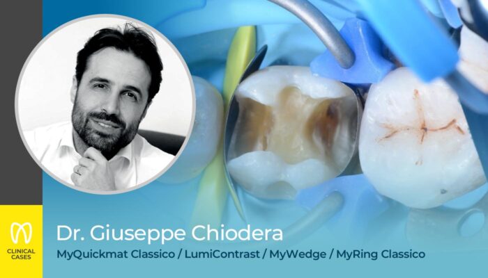caso clinico Dr Giuseppe Chiodera - restauro mod sul primo molare