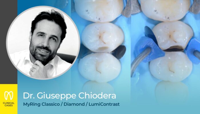 caso clinico Dr Giuseppe Chiodera - soluzioni per restauri di cavità di classe II