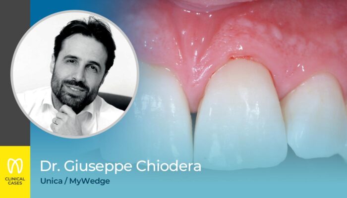 caso clinico Dr Giuseppe Chiodera - sostituzione di un restauro di classe V in composito