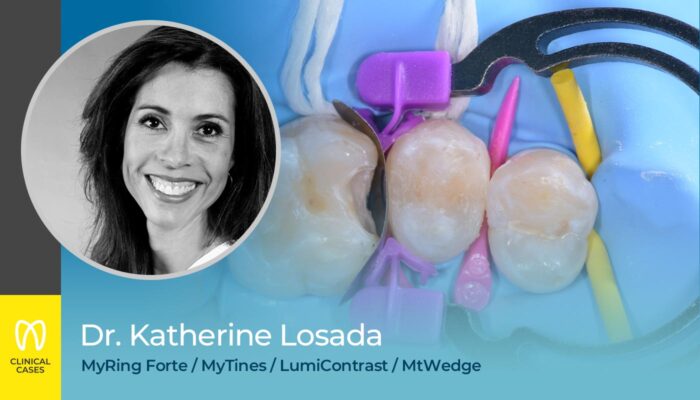 caso clinico Dr Katherine Losada - restauri multipli di classe II con risultati ottimali