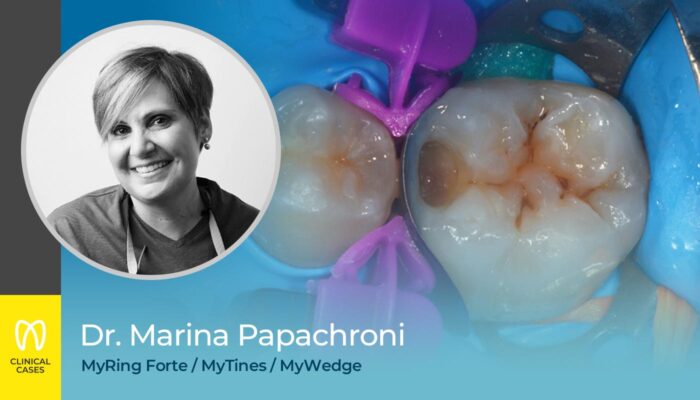 caso clinico Dr Marina Papachroni - restauro diretto di una cavità di classe II di un giovane molare permanente