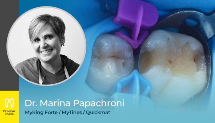 caso clinico Dr Marina Papachroni - sostituzione di un vecchio composito e restauro diretto di una cavità di classe II di un giovane molare permanente