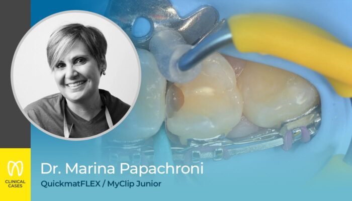 caso clinico Dr Marina Papachroni - restauro diretto di classe II del primo premolare
