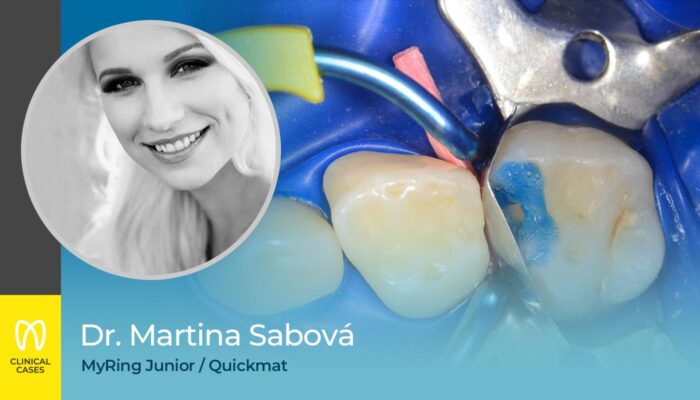 caso clinico Dr Martina Sabová - restauro di classe II di un molare primario
